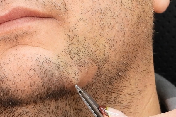 retirer poils incarnés barbe